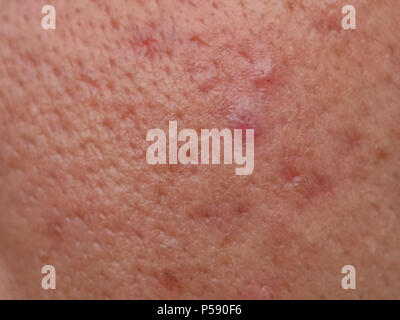 closeup skin problems, nodular cystic acne skin Stock Photo