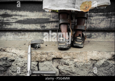 An 8 year-old girl fitted with callipers by an NGO in Goma, DRC, that assists children suffering from the effects of the polio virus Stock Photo