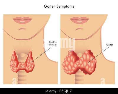 vector medical illustration of the symptoms of goiter Stock Vector