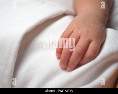 Closeup hand of a newborn with a skin peeling on white cloth. Skin allergies in newborn called Vernix. the concept of health care and medical. Stock Photo