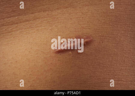 Scar on human skin close-up view. Wounf after surgery Stock Photo