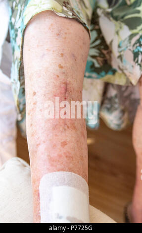 Scar on the Leg, after Injury. the Last Stage of Wound Healing, Scarring  Stock Image - Image of health, help: 192692833