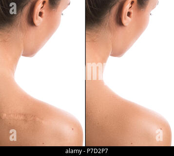 Result before and after procedure of scar removing Stock Photo