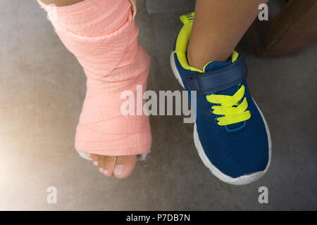 Children wearing a splint of leg broken from injury. Stock Photo