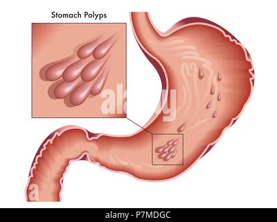 Illustrated medical drawing of stomach with polyps. Stock Vector
