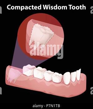 Compacted Wisdom Tooth Diagram illustration Stock Vector