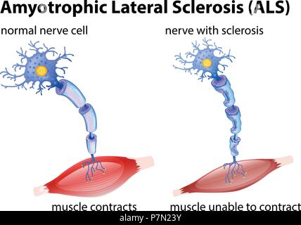 Amyotrophic lateral sclerosis ALS disease signs and symptoms ...