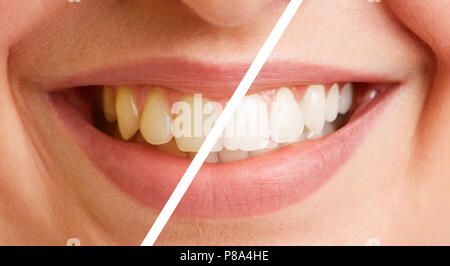 Comparison of teeth of a young woman before and after a tooth cleaning Stock Photo