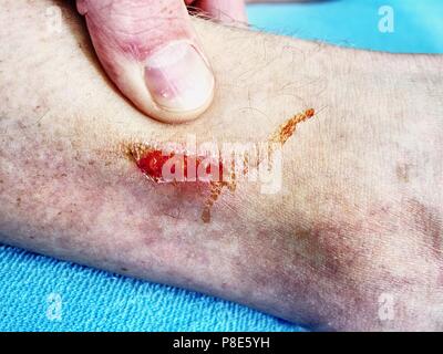 Doctors hand healing a burned skin area.  Hand embracing injured  place with painful abrasion scratches from accident. Stock Photo