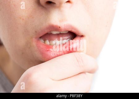 Aphtha on woman lower lip as medical discomfort or female stomatitis concept Stock Photo