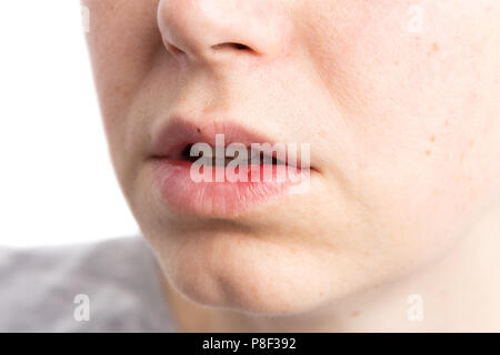 Pustule ulceration or aphtae on woman lip as painful oral mouth spot concept Stock Photo