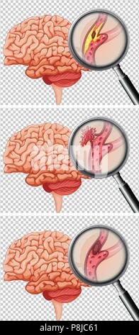 A Set of Human Brain With Stroke illustration Stock Vector