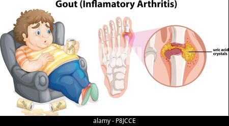 A Fat Man Gout on Foot illustration Stock Vector