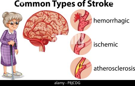 Common Types of Stroke  illustration Stock Vector