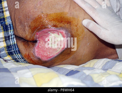 Bedsores ,Decubitus ulcer ,Pressure ulcer Stock Photo