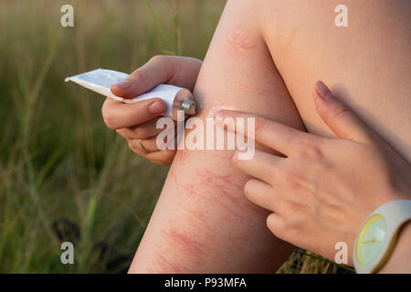 Applying first aid medication ointment on injured leg outdoors. Close up image of using ointment to heal brusied and scratched leg on hiking walking t Stock Photo