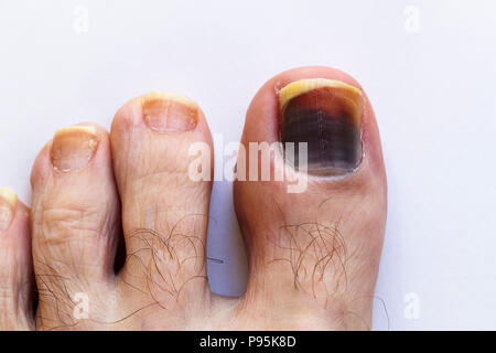 Darkened bruised big toe (hallux) toenail on the foot of a Caucasian male discoloured by bruising trauma of the nail bed (poorly fitting walking boot) Stock Photo