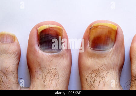 Darkened bruised big toe (hallux) toenail on the feet of a Caucasian male discoloured by bruising trauma of the nail bed (poorly fitting walking boot) Stock Photo