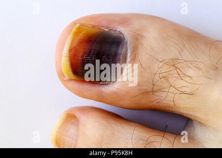 Darkened bruised big toe (hallux) toenail on the foot of a Caucasian male discoloured by bruising trauma of the nail bed (poorly fitting walking boot) Stock Photo