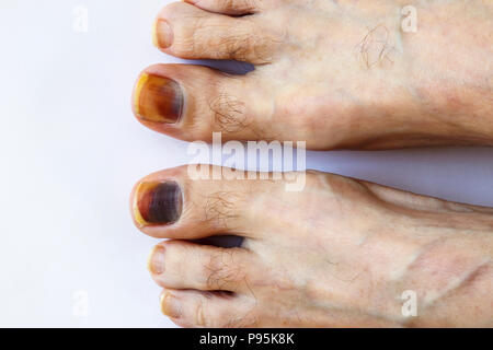 Darkened bruised big toe (hallux) toenail on the feet of a Caucasian male discoloured by bruising trauma of the nail bed (poorly fitting walking boot) Stock Photo