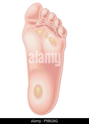 vector medical illustration of the position of calluses on the feet Stock Vector