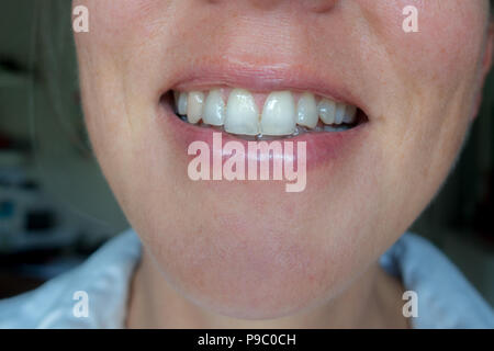 Close up of young woman smiling with translucent teeth and chipped tooth Stock Photo