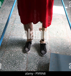 Kabul, Afghanistan. 18th July, 2018. An Afghan disabled woman stands with her prosthetic leg at the Orthopedic Center of the International Committee of the Red Cross in Kabul, capital of Afghanistan, July 18, 2018. Up to 1,692 Afghan civilians were killed as a result of conflicts and terrorist attacks in the first half of this year, hitting a record high, a UN mission said on Sunday. Credit: Rahmat Alizadah/Xinhua/Alamy Live News Stock Photo