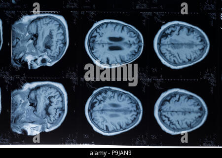 Head MRT. MR image of human brain Stock Photo