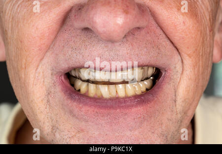 Senior man putting a night guard onto crooked teeth Stock Photo