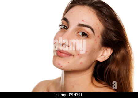 young smiling woman with problematic skin and without makeup poses on a white background Stock Photo