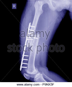 x-ray image of fracture leg (tibia )with implant plate and screw Stock ...