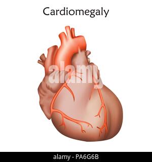 Heart Enlarged Cardiomegaly Stock Photo: 7710642 - Alamy