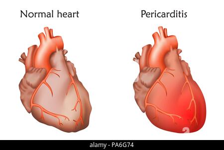 Pericarditis, illustration. Comparison between a normal heart and one with pericarditis, or inflammation of the pericardium. Stock Photo