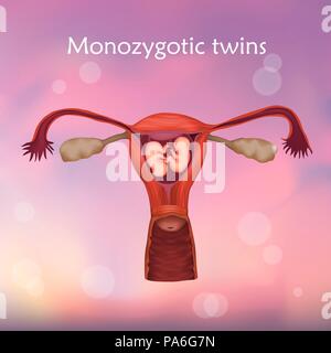 Multiple pregnancy, illustration. Monozygotic twins in the uterus sharing the same placenta. Stock Photo