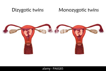 Multiple pregnancy, illustration. Dizygotic and monozygotic twins comparison. Stock Photo