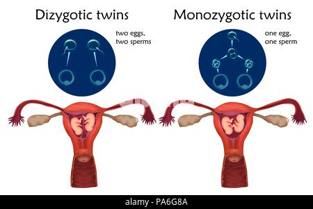 Multiple pregnancy, illustration. Dizygotic and monozygotic twins comparison. Stock Photo