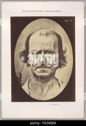 Figure 12: A study of the contraction of and the expression produced by the superior part of m. orbicularis oculi. Artist: Guillaume-Benjamin-Amand Duchenne de Boulogne (French, 1806-1875); Adrien Tournachon (French, 1825-1903). Dimensions: Image (Oval): 28.3 × 20.4 cm (11 1/8 × 8 1/16 in.)  Sheet: 29.5 × 22.1 cm (11 5/8 × 8 11/16 in.)  Mount: 40.2 × 28.5 cm (15 13/16 × 11 1/4 in.). Date: 1854-56, printed 1862. Museum: Metropolitan Museum of Art, New York, USA. Stock Photo