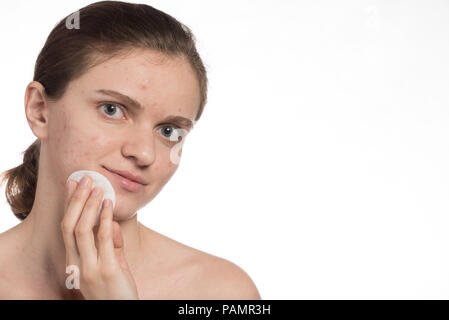 Beautiful young girl with red and white acne on her face. Before and after cream with sponge. Stop acne on a white background. Stock Photo