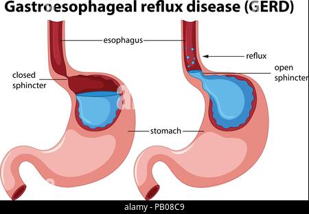 Diagram of Gastroesophageal Reflux Disease illustration Stock Vector ...