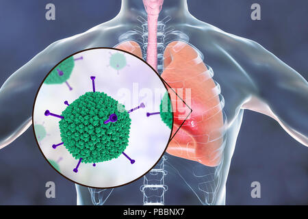 Adenoviruses infecting human lungs, computer illustration. Adenoviruses are DNA-viruses that most commonly infect the upper respiratory tract, eyes and intestine. Occasionally they can cause lower respiratory tract infection (pneumonia), especially in children and immunocompromised patients. Stock Photo
