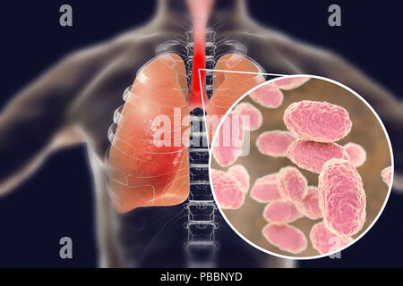 Whooping cough, conceptual illustration. Whooping cough is a highly contagious infectious disease caused by Bordetella pertussis bacteria. Stock Photo