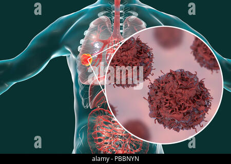 Lung cancer. Computer illustration showing a cancerous tumour in the lung and a close-up view of lung cancer cells. Stock Photo