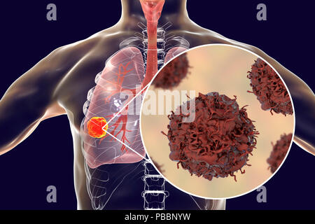 Lung cancer. Computer illustration showing a cancerous tumour in the lung and a close-up view of lung cancer cells. Stock Photo