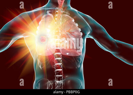 Treatment and prevention of lung cancer, conceptual computer illustration. Stock Photo