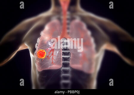 Lung cancer, computer illustration. Stock Photo