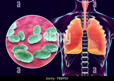 Pneumonia caused by Haemophilus influenzae bacteria, computer illustration. H. influenzae are coccobacillus Gram-negative bacteria. These bacteria cause a number of diseases including meningitis in children, pneumonia, epiglottitis, laryngitis, conjunctivitis, neonatal infection, otitis media (middle ear infection) and sinusitis in adults. H. influenzae harmlessly colonize the upper respiratory tract in most humans within the first few months of life. Encapsulated strains spread to cause diseases such as bronchitis and pneumonia. Stock Photo