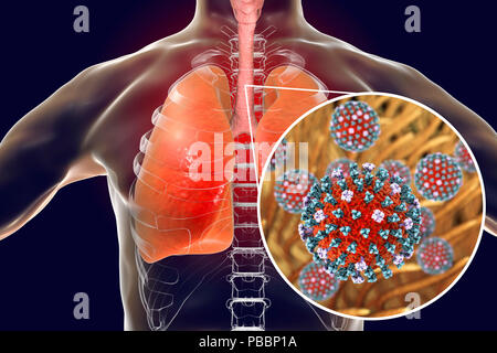 Flu viruses in trachea, computer illustration. Influenza viruses have tropism to tracheal epithelium, they decrease tracheal mucociliary velocity thus contributing to the development of secondary infections of the lower respiratory tract. Due to this, pneumonia is one of the more common complications of flu infection. Stock Photo