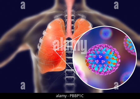Pneumonia caused by flu, computer illustration. Pneumonia is one of the common complications of a flu infection. Stock Photo