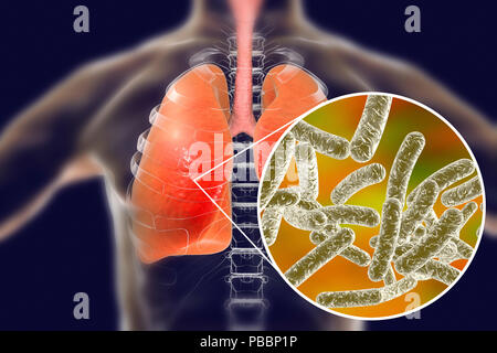 Legionnaires' disease, conceptual computer illustration. Legionella pneumophila bacteria are the cause of Legionnaires' disease. These bacilli (rod-shaped bacteria) are Gram-negative. L. pneumophila was identified as a pathogen after a mysterious outbreak of pneumonia caused 29 deaths at an American Legion convention in 1976. This bacterium was found living in water tanks, showerheads and air-conditioning systems. The disease causes fatal pneumonic lung damage in the elderly and unfit. Stock Photo