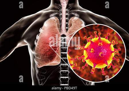 MERS virus infection of lungs, conceptual illustration. MERS (Middle East respiratory syndrome) is a viral respiratory illness caused by the MERS-associated coronavirus (MERS-CoV). Formerly known as novel coronavirus, MERS was first identified in Saudi Arabia in 2012. Most people infected with MERS develop severe acute respiratory illness with symptoms of fever, cough, and shortness of breath. Stock Photo